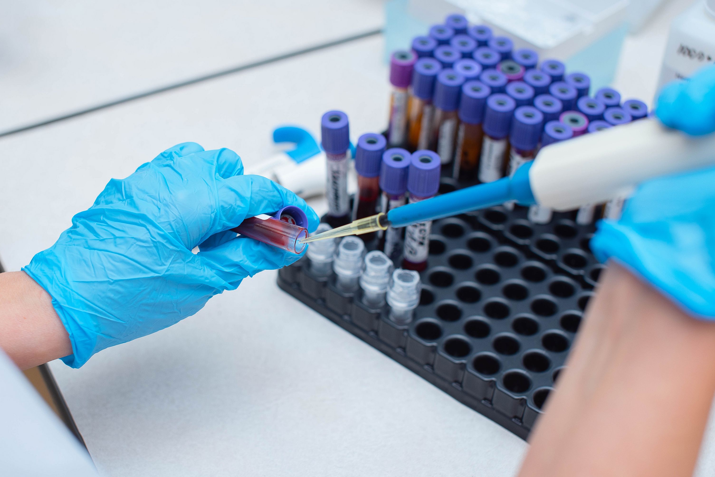 Atitus integra estudo de teste diagnóstico para Alzheimer